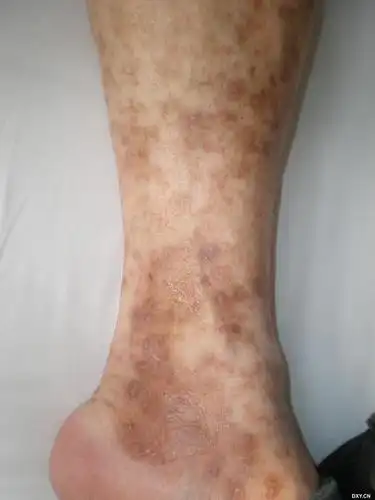 常见皮肤疾病典型图片汇总 - 疫情的典型症状有哪些图片 - 实验室设备