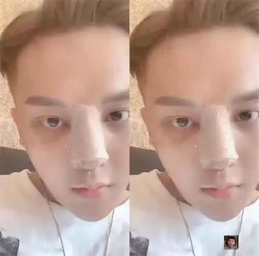 小猪先生陪韩安冉同步隆鼻,直播吐槽整容很难受,这是真爱无疑了