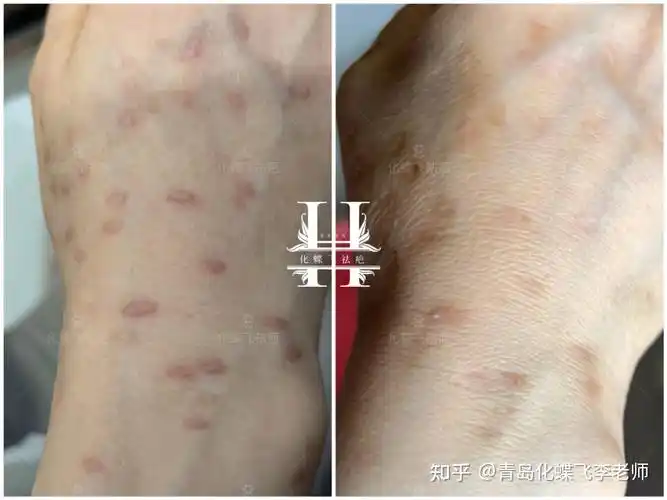 点扁平疣引起的增生疤痕 - 知乎