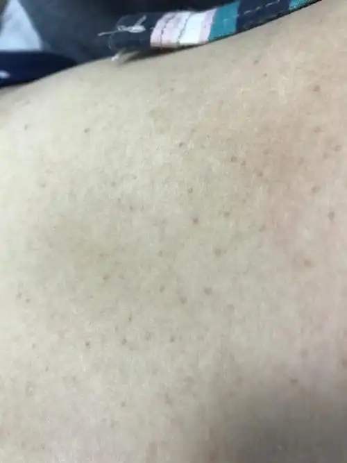 肚子上出现的一颗颗圆圆的点,不痛不痒,又有点像斑点,请问这是什么