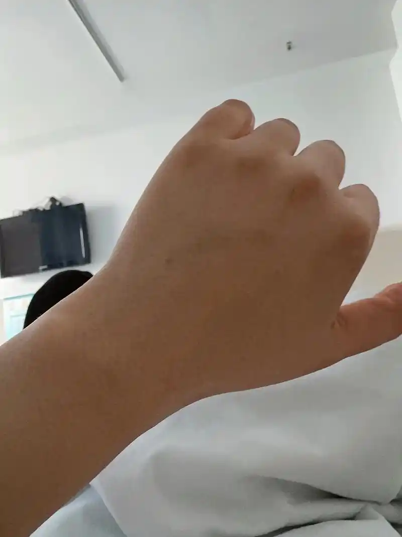 混合痔术后第七天