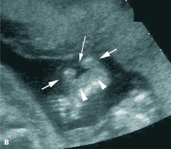 二维三维四维彩超下的唇腭裂胎儿都是怎样的你可能想象不到