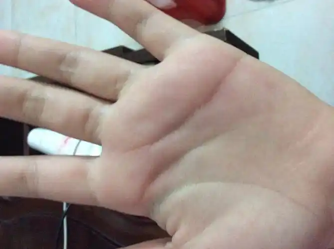 被老师后红肿很痛一天都没有消掉手心今天以前打得不疼