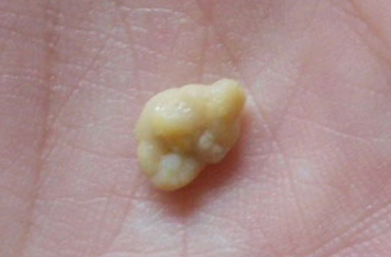 扁桃体结石可以不管吗?