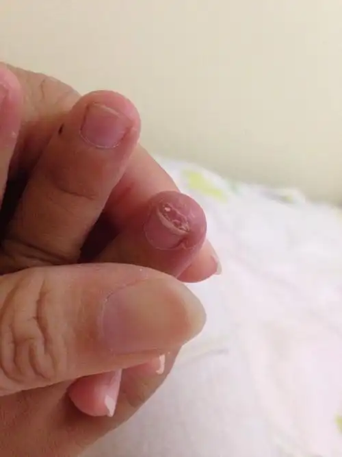 宝宝手指头破皮还痒痒是什么病啊?宝宝快三岁了.