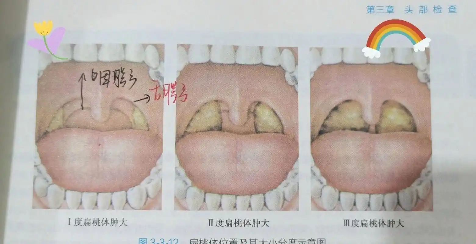扁桃体肿大分级  1度:不超过咽腭弓 2度:超过咽腭弓者 3度:达到或超过