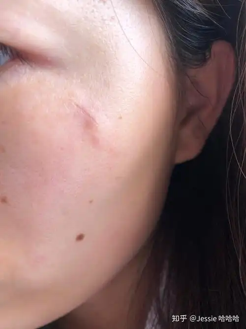 手术切除粉瘤皮脂腺囊肿是一种什么样的体验