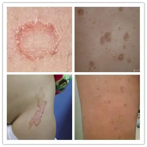 播散型掌跖合并汗孔角化症(pppd);4. 掌跖点状汗孔角化症(pppp);3.