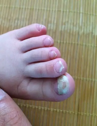 宝宝一岁半,脚指甲(如图)是灰指甲吗?