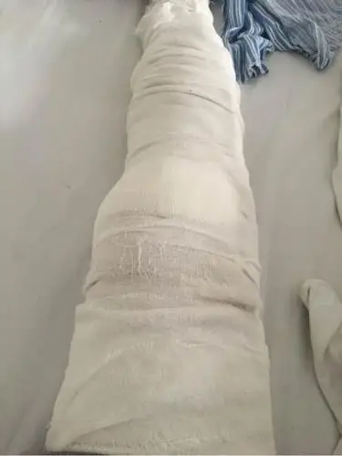 髌骨骨折要固定多久呢