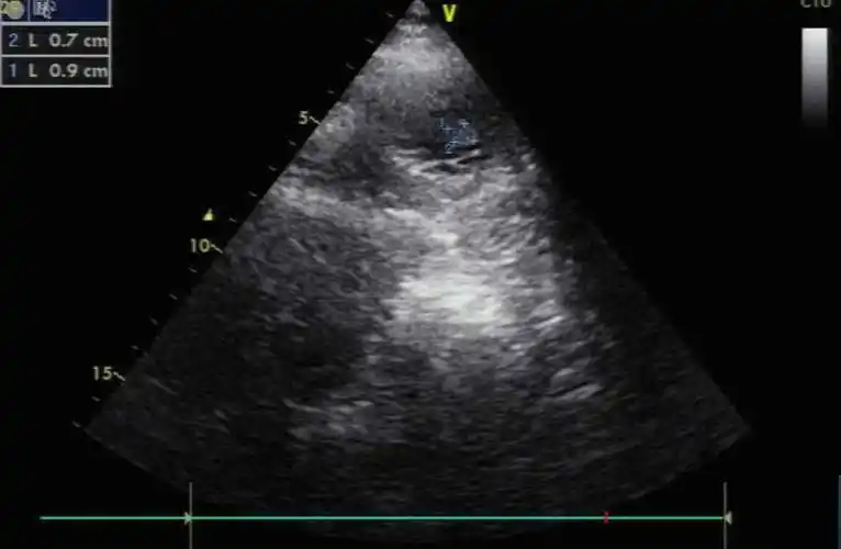 胸骨旁左心室短轴切面上魏相东读图谈心零基础入门心脏超声