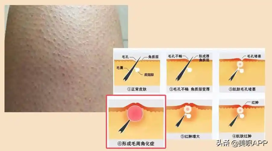 去毛周角化也要分种类好吗?