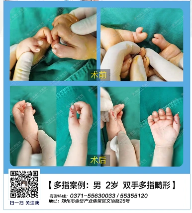 郑州哪家骨科医院治疗六指效果好?