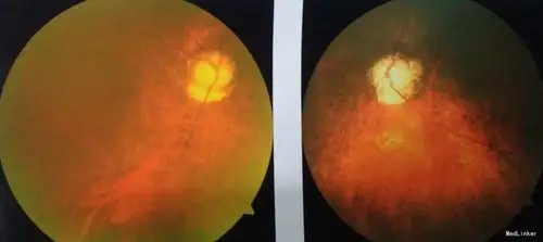 原发性开角型青光眼