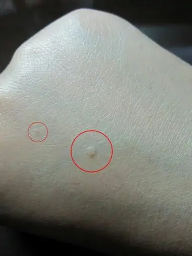 脚部扁平疣症状图片