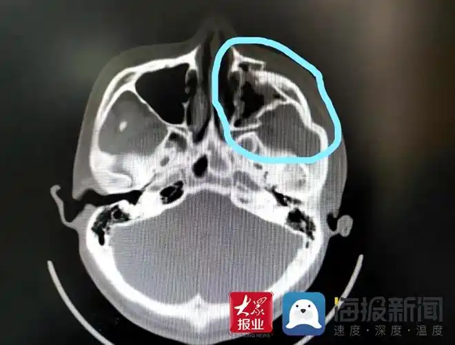 菏泽一小伙面部多处骨折 市立医院口腔团队为其"重塑面容"