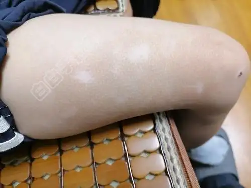 小儿腿部白斑求助该怎么确诊