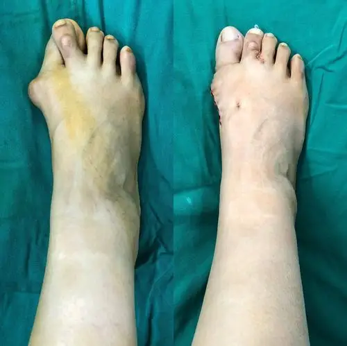拇外翻交叉趾畸形矫正术,患者因足趾疼痛就医.