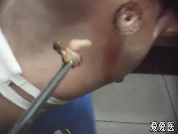 我见过的最大的鸡眼,你们见过吗?