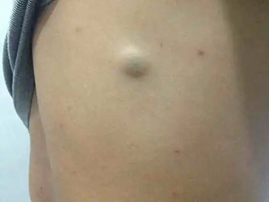 皮肤囊肿图片 (30)_有来医生
