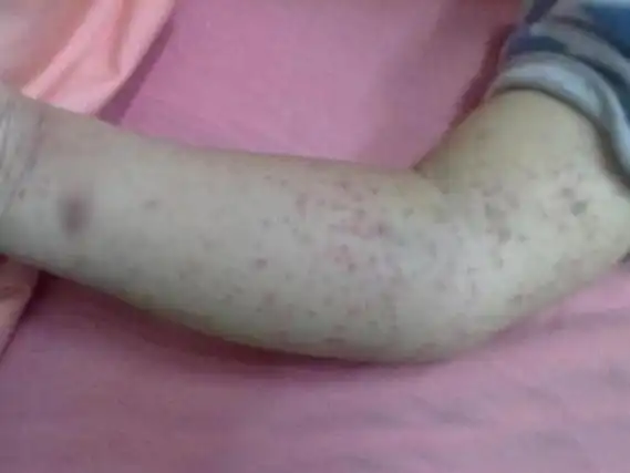 白血病早期红疹图片长什么样