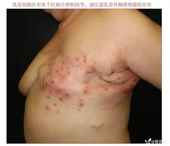 经典病例学习乳腺术区出现多个红斑硬性丘疹和结节