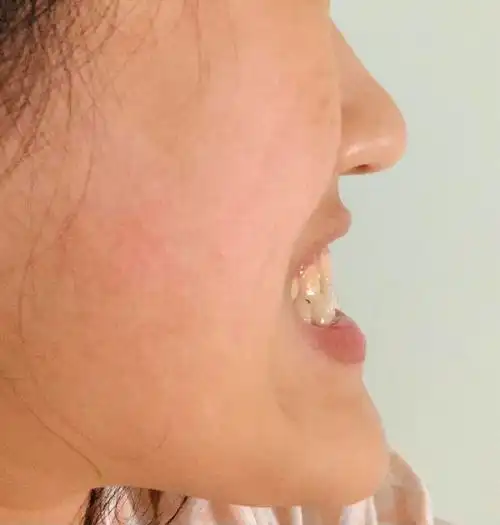 骨性地包天还有必要二次矫正或者做正颌手术吗?(已解决)