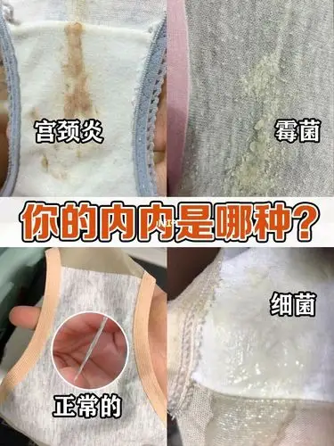 你的内内是哪种白带异常妇科炎症别再拖了