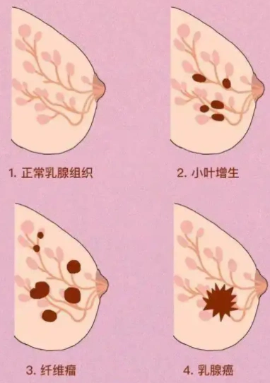 中国乳腺肿瘤医院排名