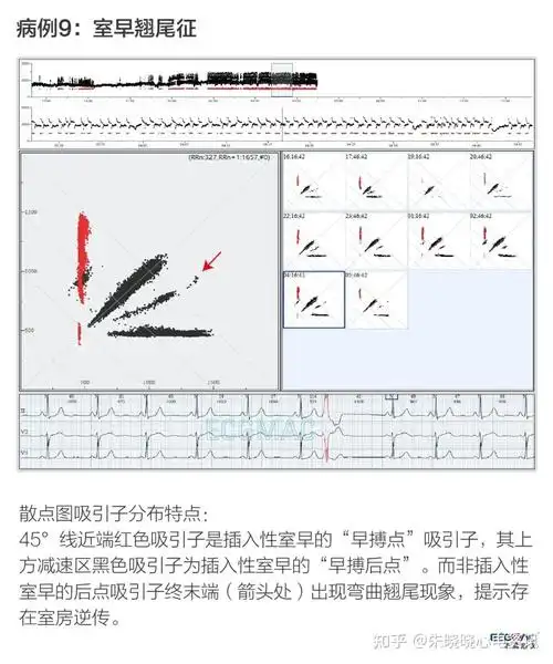 收藏心电散点图图谱精选中