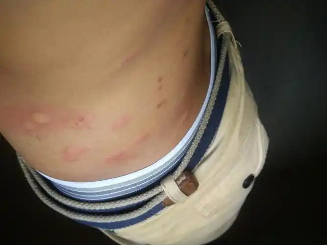 过敏吗!昨天晚上打死了一只虫子