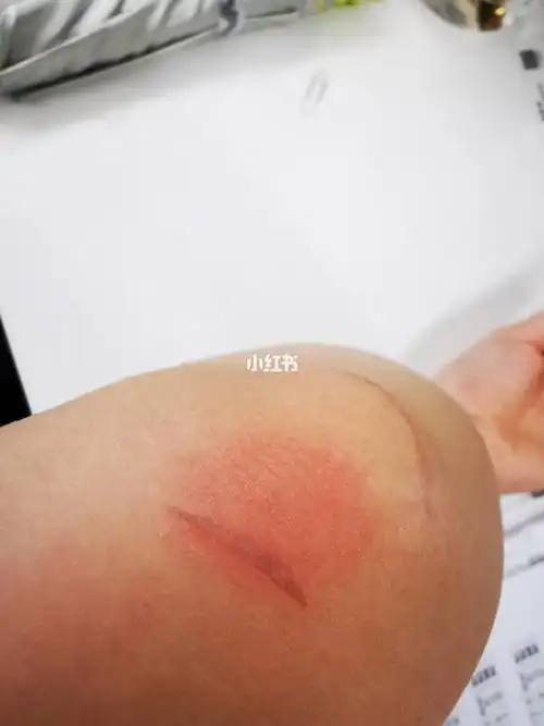 被慕金脱毛仪烫伤