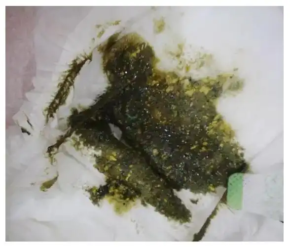 胎便的颜色接近于墨绿色,粘稠,似柏油样,有些会偏深,呈黑色