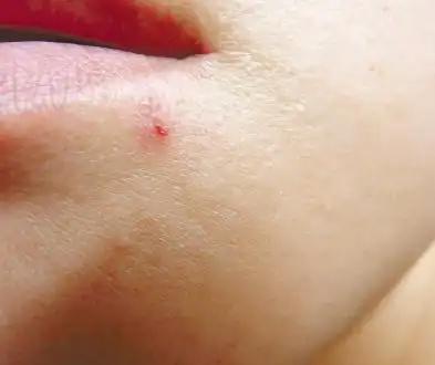 杭州姑娘非洲旅游后身体里挤出虫子:皮肤蝇!