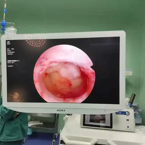 刀过无痕妇科微创之宫腔镜