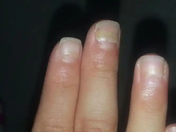 请教大虾,三岁多的小孩儿手指甲盖脱落是怎么回事,拍了几张图,大家