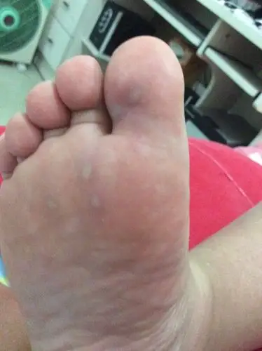 脚底板长了几个白色的泡,刚开始很疼走路也疼,第二天这些白的东西才能