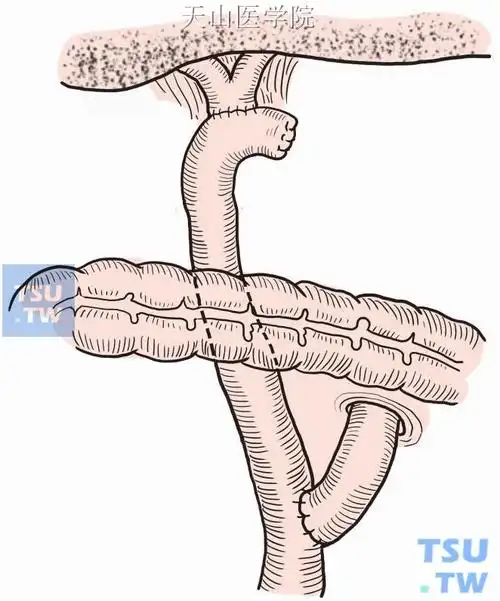 先天性胆总管扩张症囊肿切除肝胆管空肠吻合术