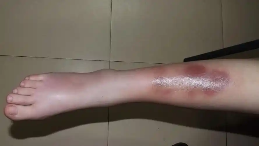 丹毒的护理措施