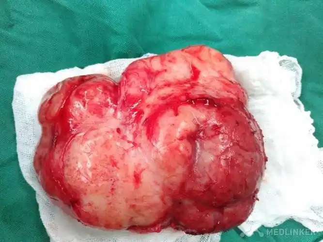 巨大乳腺纤维腺瘤1例