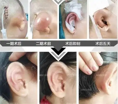 国内耳朵整形医院价格表一览公办私立耳朵整形价格都有