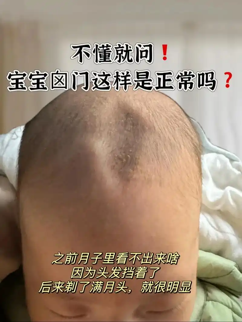 有没有人能告诉我宝宝囟门这样是正常吗71