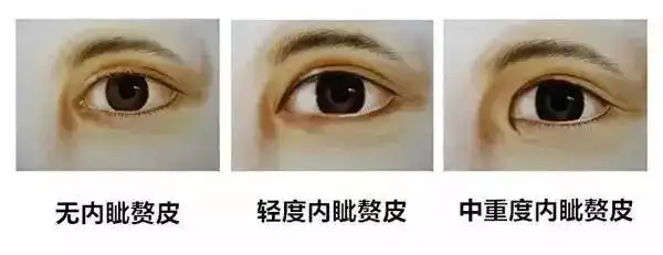 内眦赘皮轻重度程度