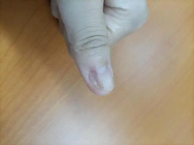 指甲这样子需要拔掉重新长吗