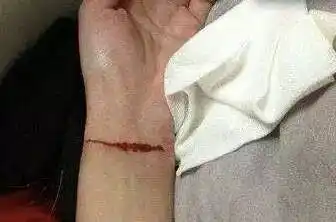 你一刀我一刀…姑娘失恋割腕闺蜜陪割!网友:你们还要啥男友啊