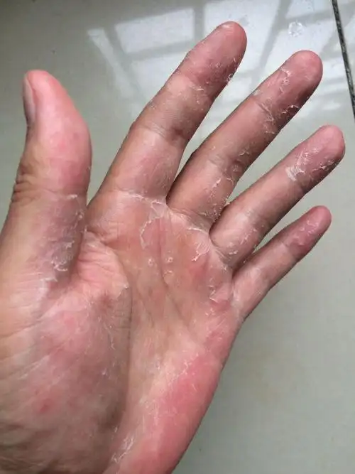 手气,真菌感染,前几天发现手上起小白点痘痘,还很痒,也没在意,结果几