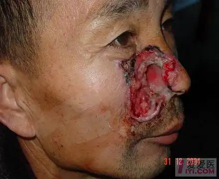 颊癌的罕见照片 - 口腔医学专业讨论版 - 爱爱医医学论坛