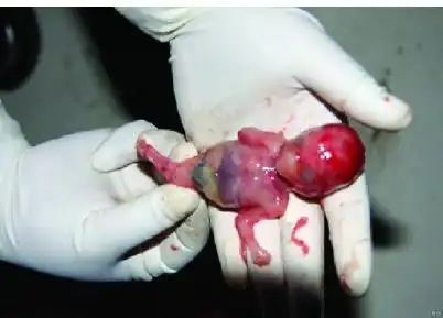 后经引产证实(图2).图1 人体鱼序列综合征声像图