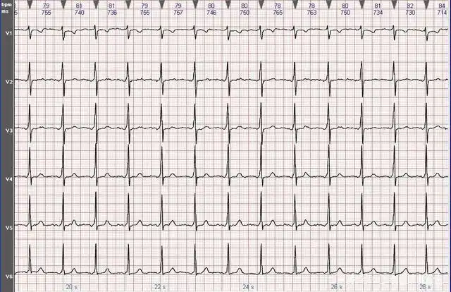 一份心电图是不是属于正常,重点看以下几点