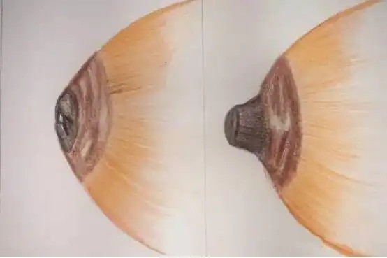 小心,乳房的这种变化,不及时治疗会有大隐患|乳头|乳腺|导管|炎症